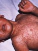 Measles