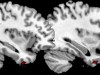 Psychopathy linked to physical brain abnormalities